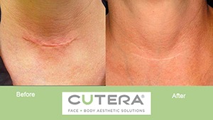laser treatment in  scar reduction