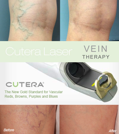 image of vein therapy before and after treatment with the Cutera nd-yag laser used in the Bolton clinic